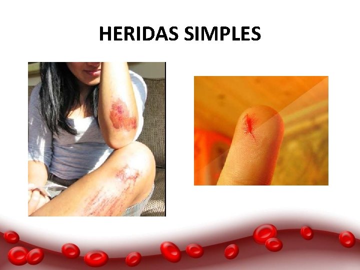 HERIDAS SIMPLES 