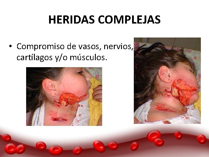 HERIDAS COMPLEJAS • Compromiso de vasos, nervios, cartílagos y/o músculos. 