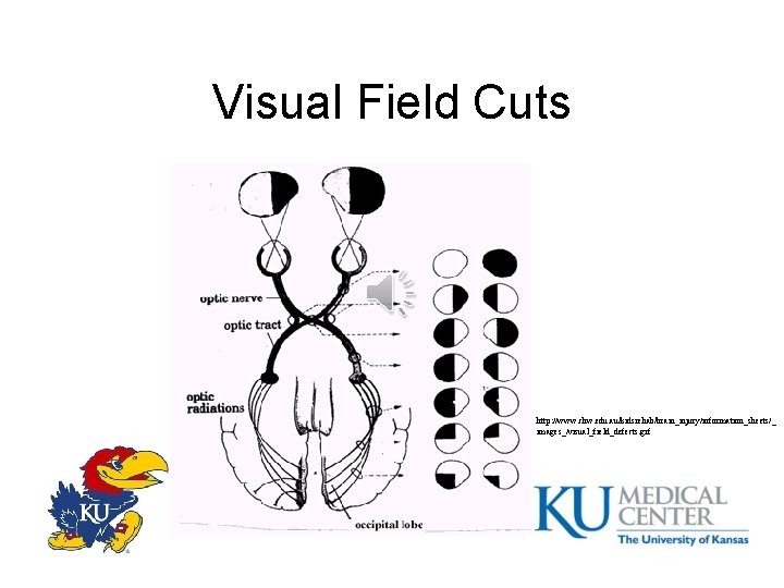 Visual Field Cuts http: //www. chw. edu. au/kidsrehab/brain_injury/information_sheets/_ images_/visual_field_defects. gif 