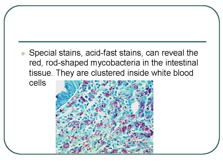 l Special stains, acid-fast stains, can reveal the red, rod-shaped mycobacteria in the intestinal l Special stains, acid-fast stains, can reveal the red, rod-shaped mycobacteria in the intestinal
