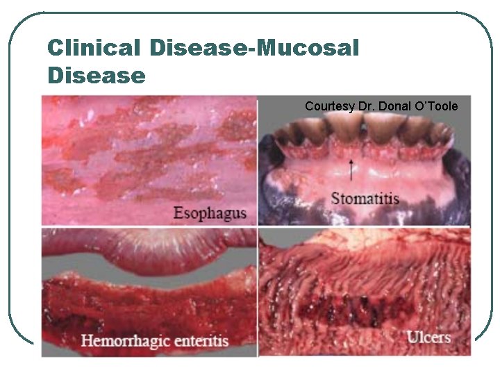 Clinical Disease-Mucosal Disease Courtesy Dr. Donal O’Toole Clinical Disease-Mucosal Disease Courtesy Dr. Donal O’Toole