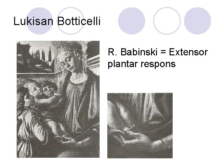 Lukisan Botticelli R. Babinski = Extensor plantar respons 