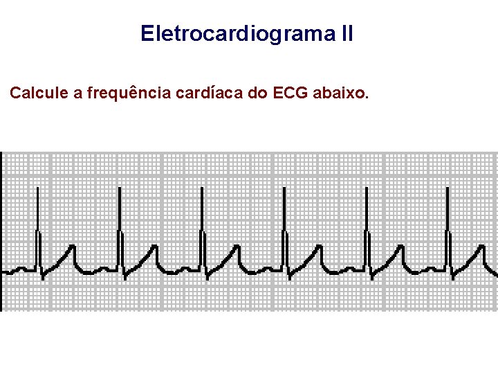 Eletrocardiograma II Calcule a frequência cardíaca do ECG abaixo. 