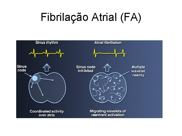 Fibrilação Atrial (FA) 
