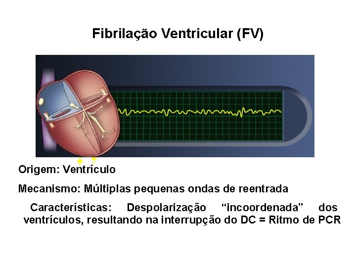 Fibrilação Ventricular (FV) Origem: Ventrículo Mecanismo: Múltiplas pequenas ondas de reentrada Características: Despolarização “incoordenada”