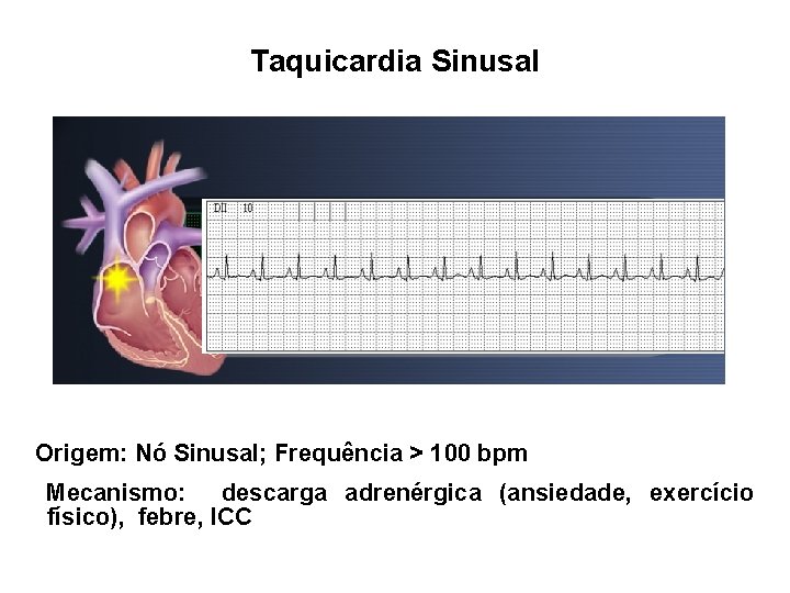 Taquicardia Sinusal Origem: Nó Sinusal; Frequência > 100 bpm Mecanismo: descarga adrenérgica (ansiedade, exercício