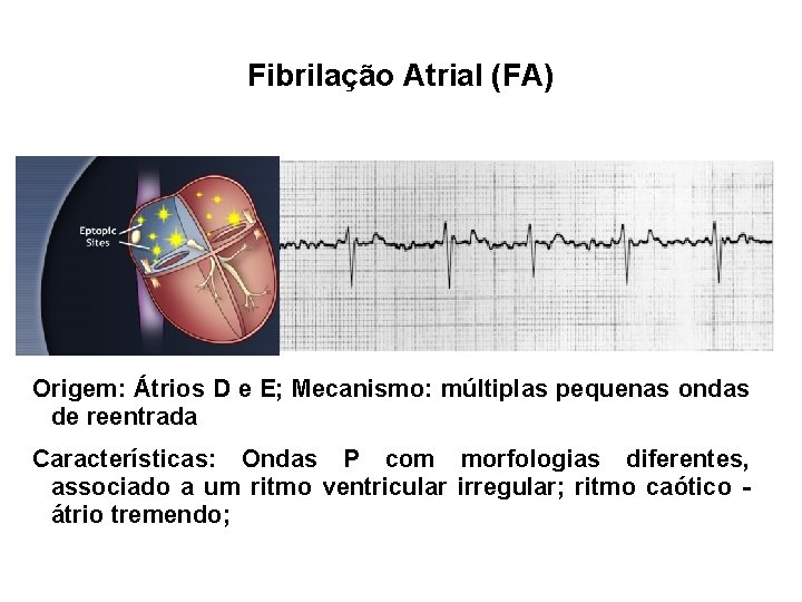 Fibrilação Atrial (FA) Origem: Átrios D e E; Mecanismo: múltiplas pequenas ondas de reentrada
