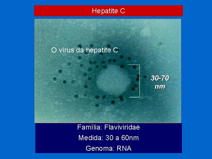 Hepatite C O vírus da hepatite C Família: Flaviviridae Medida: 30 a 60 nm Hepatite C O vírus da hepatite C Família: Flaviviridae Medida: 30 a 60 nm