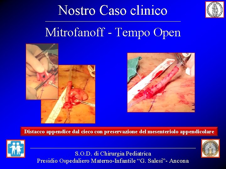 Nostro Caso clinico Mitrofanoff - Tempo Open Distacco appendice dal cieco con preservazione del