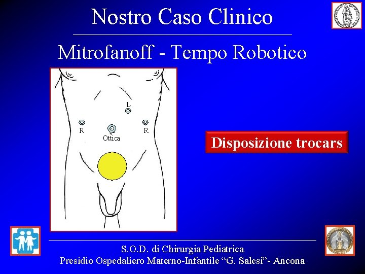 Nostro Caso Clinico Mitrofanoff - Tempo Robotico L R Ottica R Disposizione trocars S.