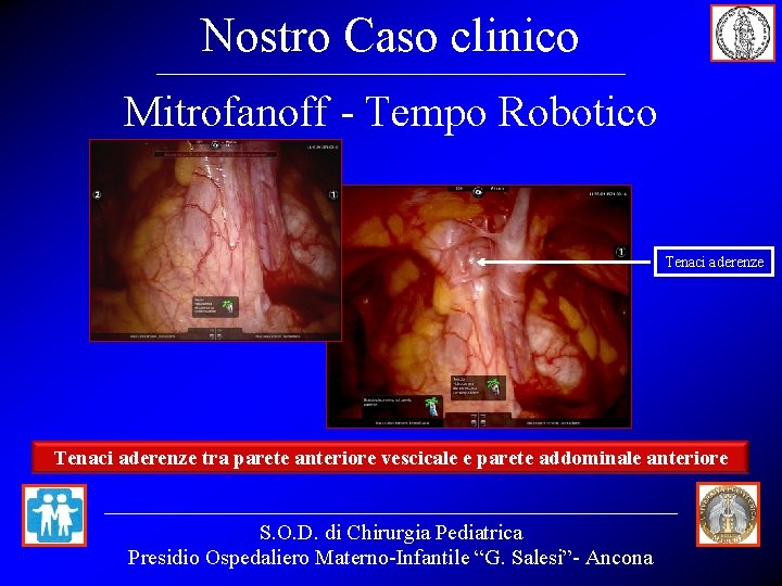 Nostro Caso clinico Mitrofanoff - Tempo Robotico Tenaci aderenze tra parete anteriore vescicale e