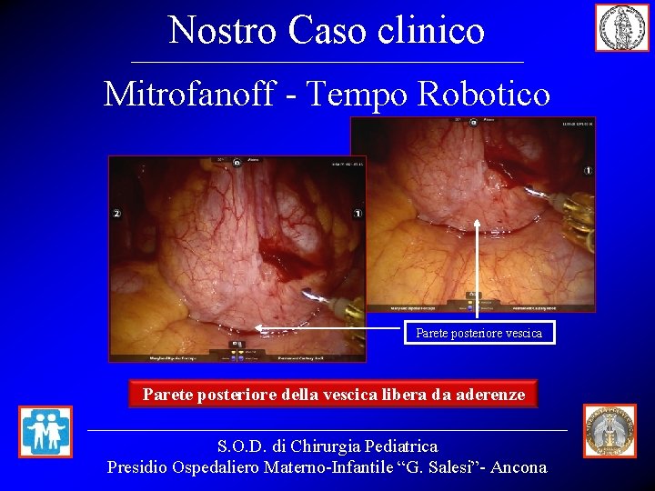 Nostro Caso clinico Mitrofanoff - Tempo Robotico Parete posteriore vescica Parete posteriore della vescica