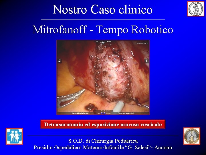 Nostro Caso clinico Mitrofanoff - Tempo Robotico Detrusorotomia ed esposizione mucosa vescicale S. O.