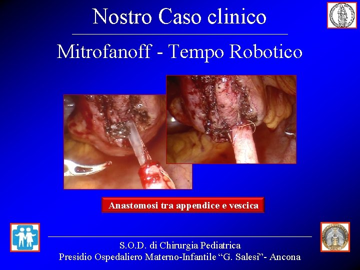 Nostro Caso clinico Mitrofanoff - Tempo Robotico Anastomosi tra appendice e vescica S. O.