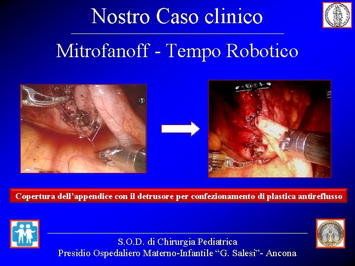 Nostro Caso clinico Mitrofanoff - Tempo Robotico Copertura dell’appendice con il detrusore per confezionamento