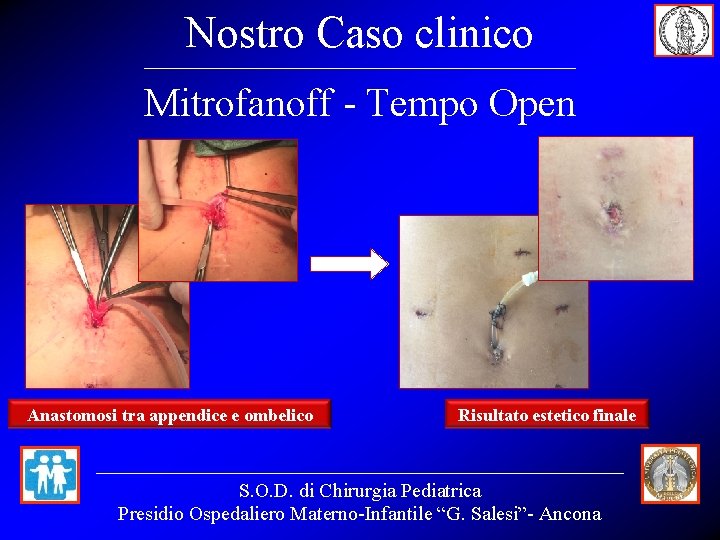 Nostro Caso clinico Mitrofanoff - Tempo Open Anastomosi tra appendice e ombelico Risultato estetico