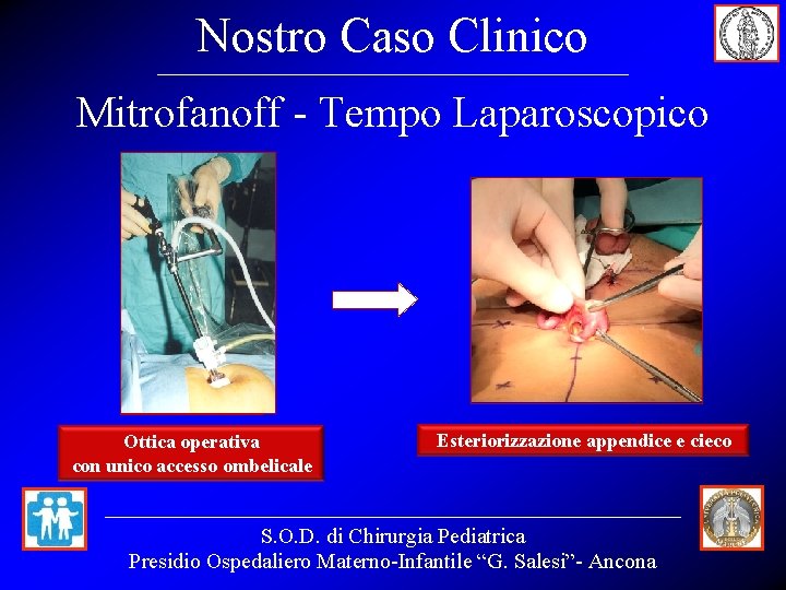 Nostro Caso Clinico Mitrofanoff - Tempo Laparoscopico Ottica operativa con unico accesso ombelicale Esteriorizzazione Nostro Caso Clinico Mitrofanoff - Tempo Laparoscopico Ottica operativa con unico accesso ombelicale Esteriorizzazione