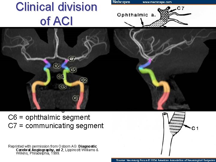 Clinical division of ACI Bouthillier‘s classification: C 1 = cervical segment (the bulb is