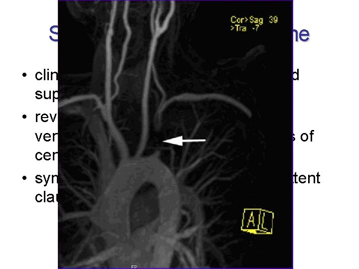 Subclavian steal syndrome • clinically significant reduction in blood supply to brain stem and