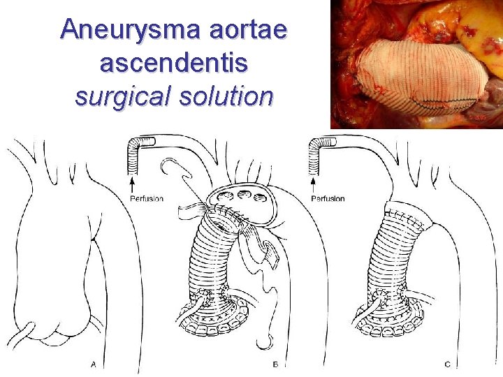 Aneurysma aortae ascendentis surgical solution 