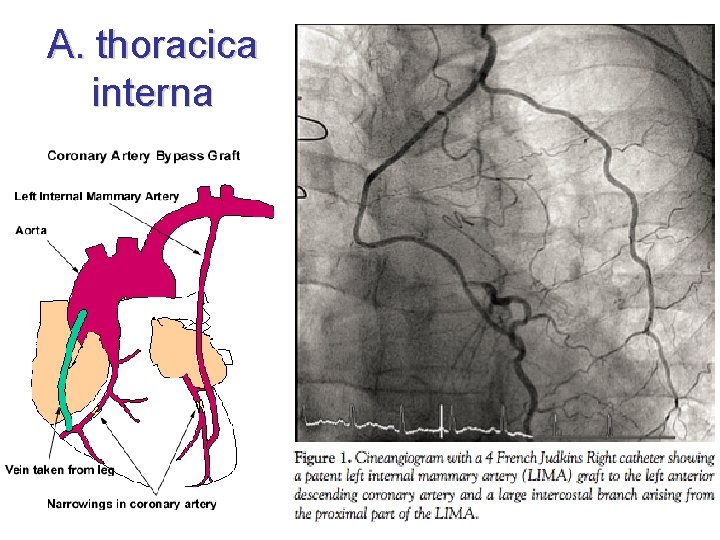 A. thoracica interna 