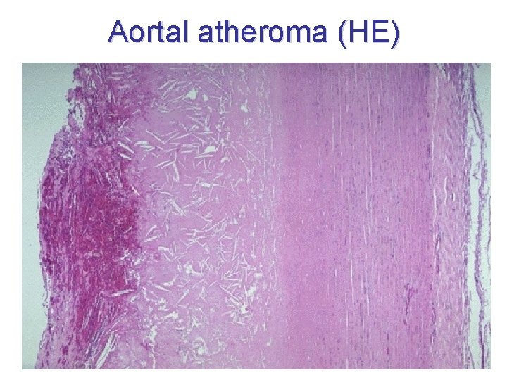 Aortal atheroma (HE) 