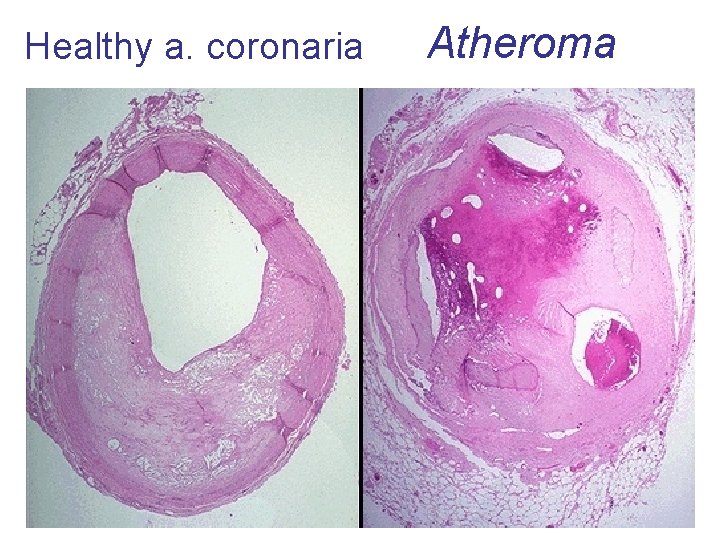 Healthy a. coronaria Atheroma 