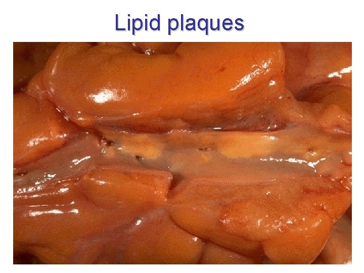 Lipid plaques 