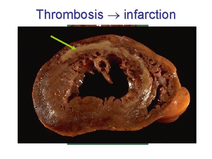 Thrombosis infarction 