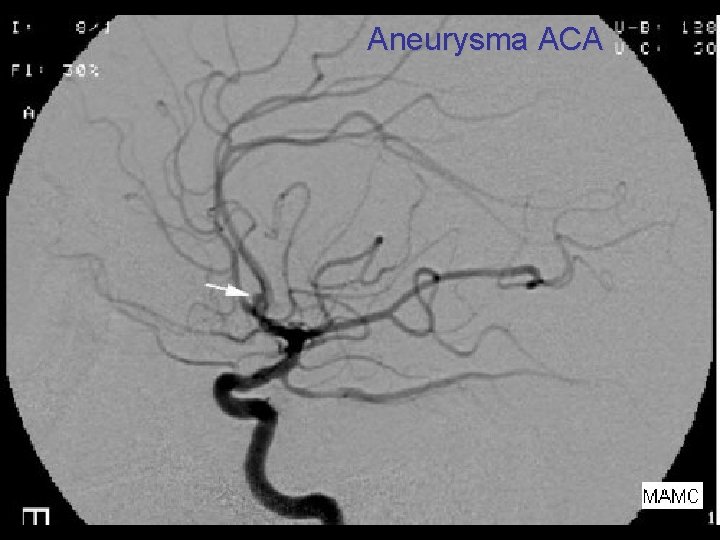 Aneurysma ACA 