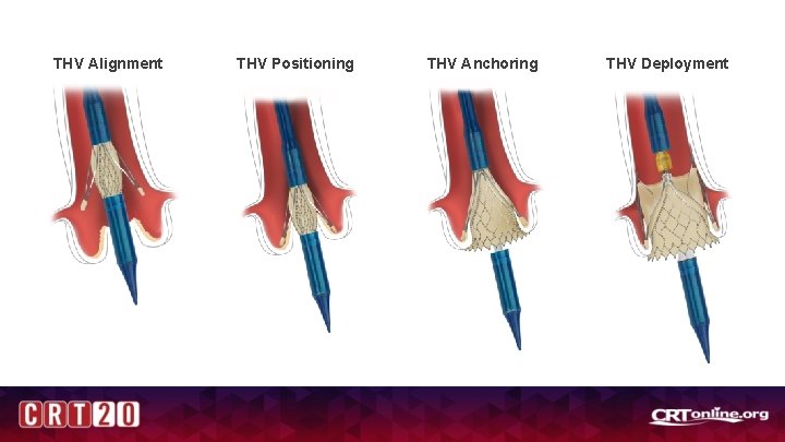 THV Alignment THV Positioning THV Anchoring THV Deployment 