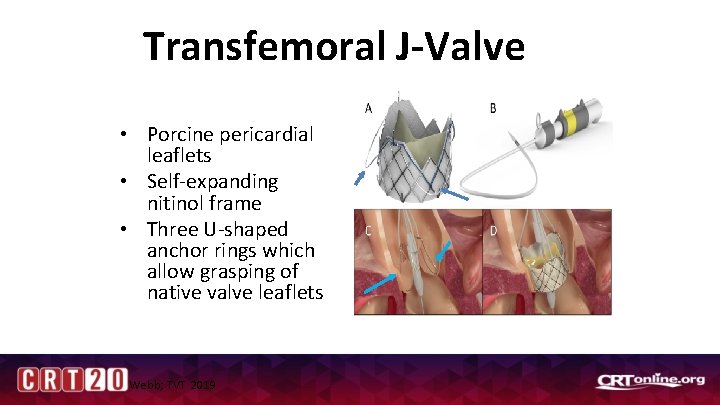 Transfemoral J-Valve • Porcine pericardial leaflets • Self-expanding nitinol frame • Three U-shaped anchor