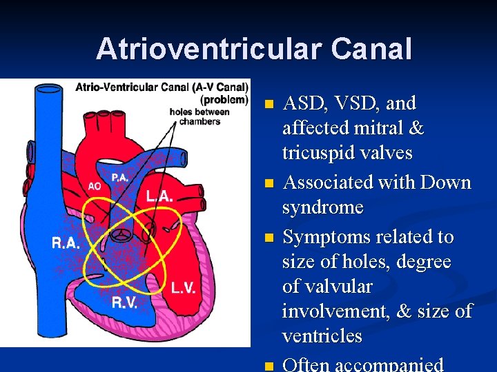 Atrioventricular Canal n n n ASD, VSD, and affected mitral & tricuspid valves Associated