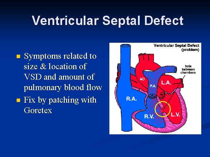 Ventricular Septal Defect n n Symptoms related to size & location of VSD and