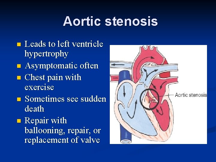 Aortic stenosis n n n Leads to left ventricle hypertrophy Asymptomatic often Chest pain