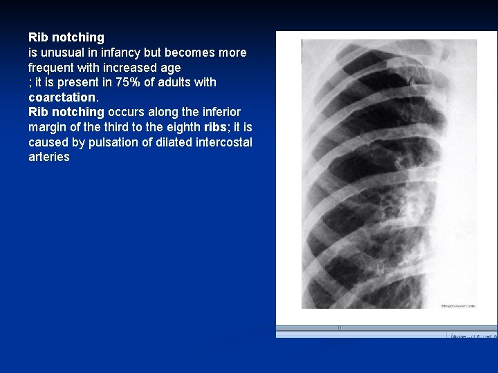 Rib notching is unusual in infancy but becomes more frequent with increased age ;