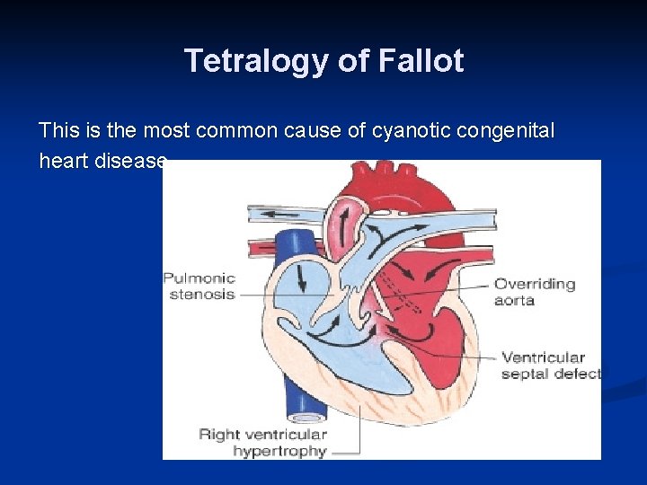 Tetralogy of Fallot This is the most common cause of cyanotic congenital heart disease.