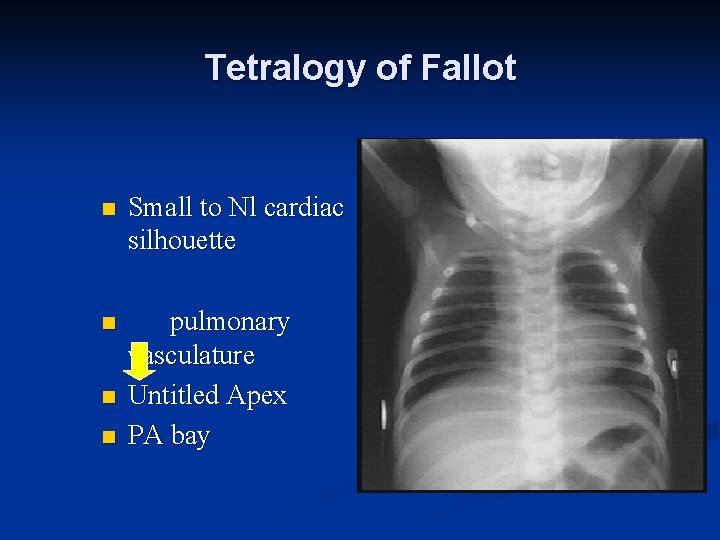 Tetralogy of Fallot n Small to Nl cardiac silhouette n pulmonary vasculature Untitled Apex