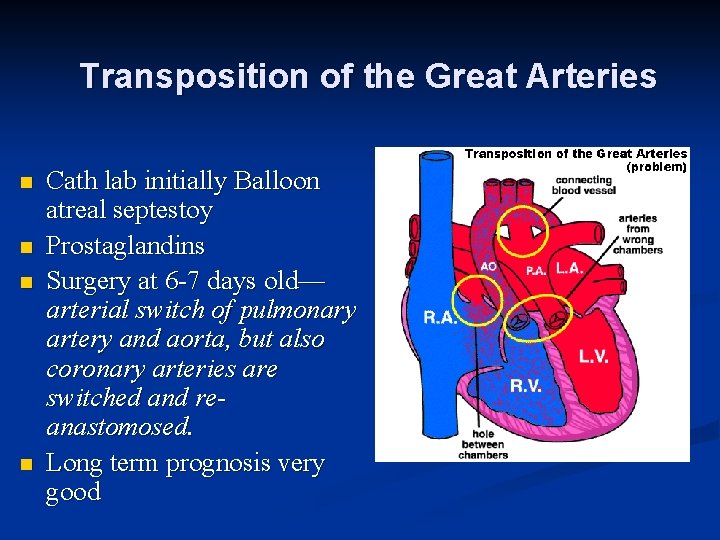 Transposition of the Great Arteries n n Cath lab initially Balloon atreal septestoy Prostaglandins