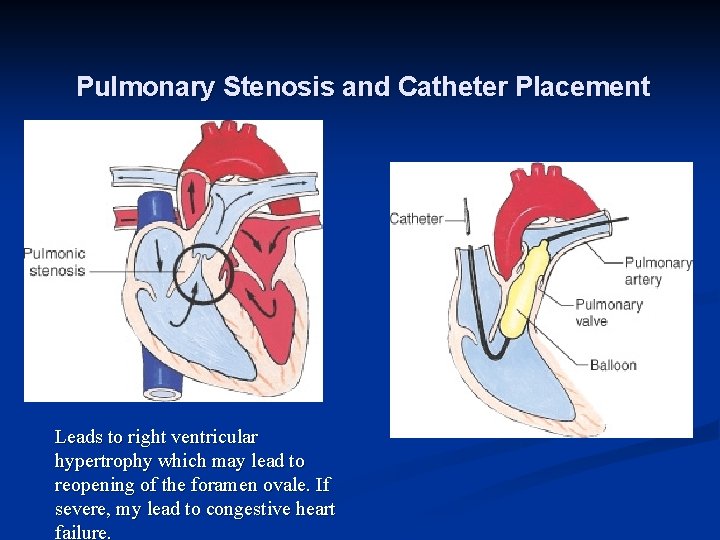 Pulmonary Stenosis and Catheter Placement Leads to right ventricular hypertrophy which may lead to