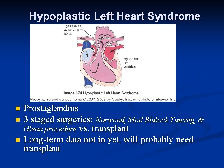 Hypoplastic Left Heart Syndrome n n n Prostaglandins 3 staged surgeries: Norwood, Mod Blalock