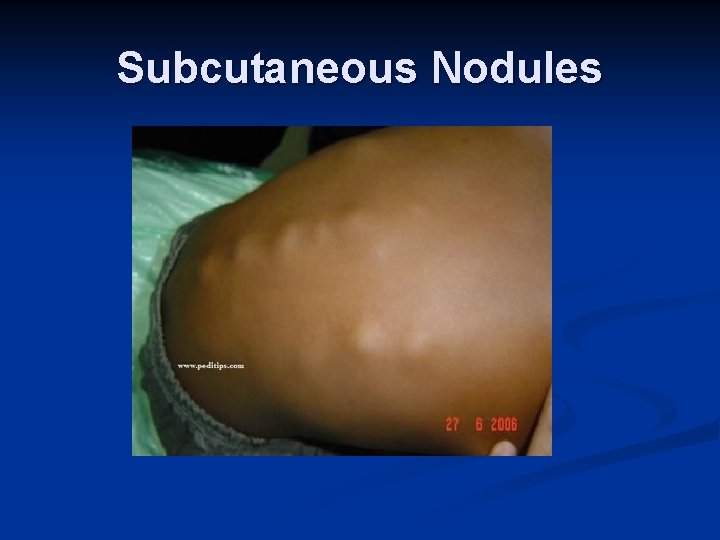 Subcutaneous Nodules 