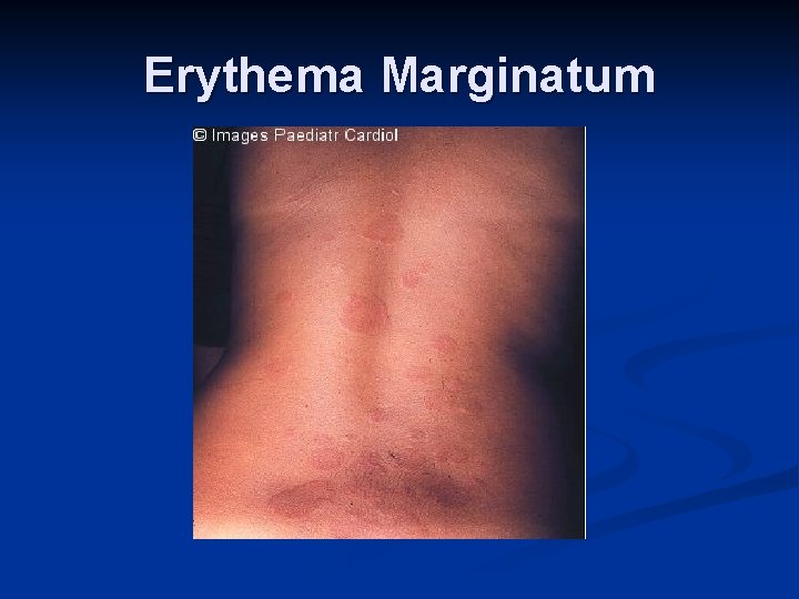 Erythema Marginatum 