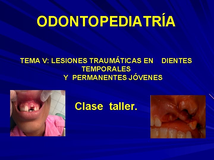 ODONTOPEDIATRÍA TEMA V: LESIONES TRAUMÁTICAS EN DIENTES TEMPORALES Y PERMANENTES JÓVENES Clase taller. 