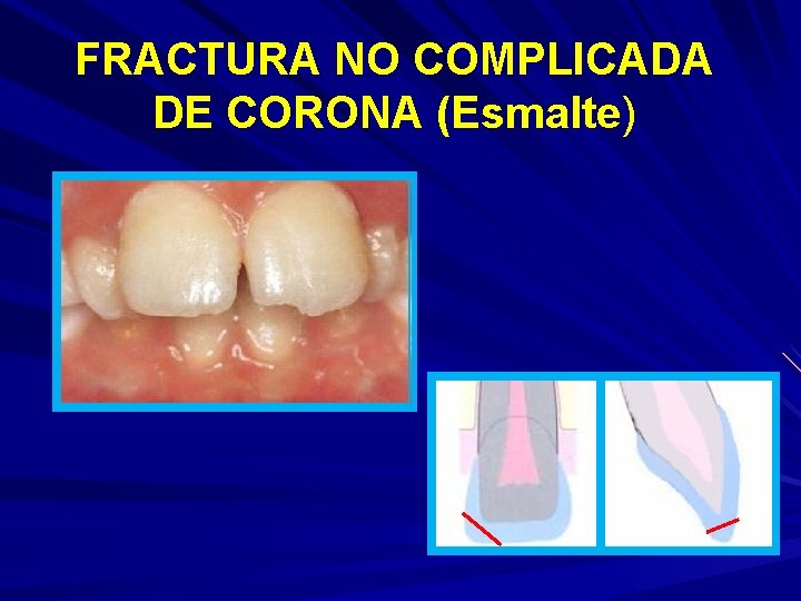 FRACTURA NO COMPLICADA DE CORONA (Esmalte) 