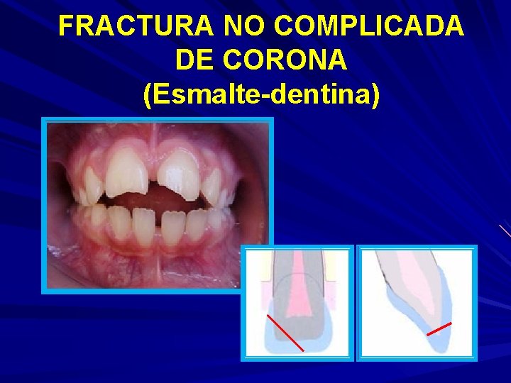 FRACTURA NO COMPLICADA DE CORONA (Esmalte-dentina) 