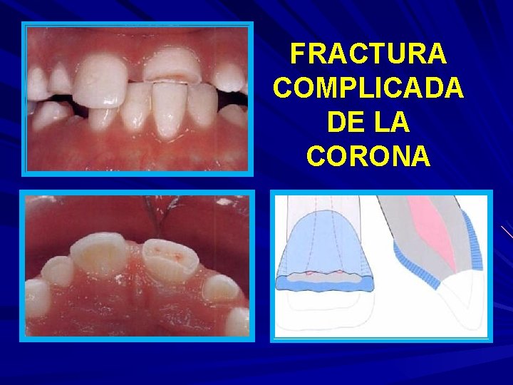 FRACTURA COMPLICADA DE LA CORONA 