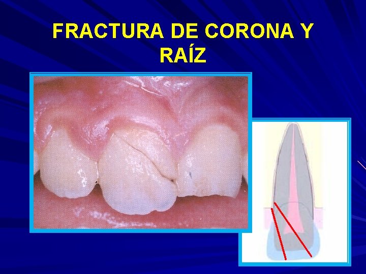 FRACTURA DE CORONA Y RAÍZ 