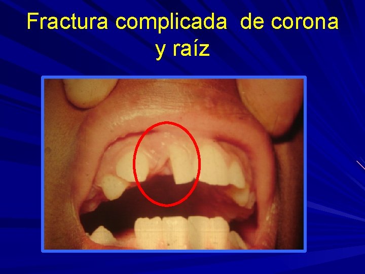 Fractura complicada de corona y raíz 