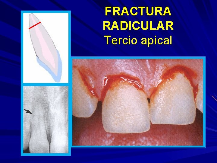 FRACTURA RADICULAR Tercio apical 